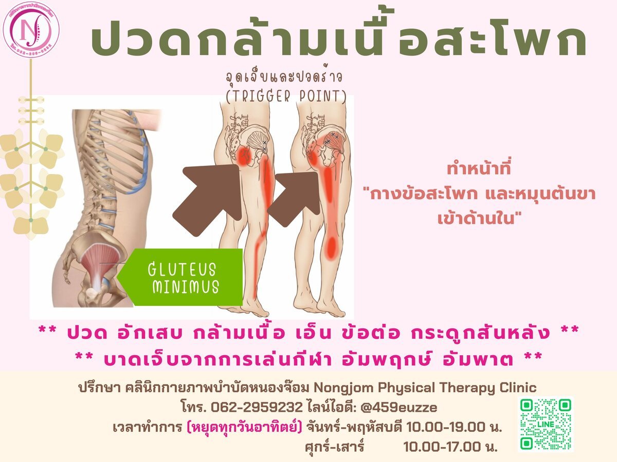 จุดปวดร้าว Gluteus Minimus