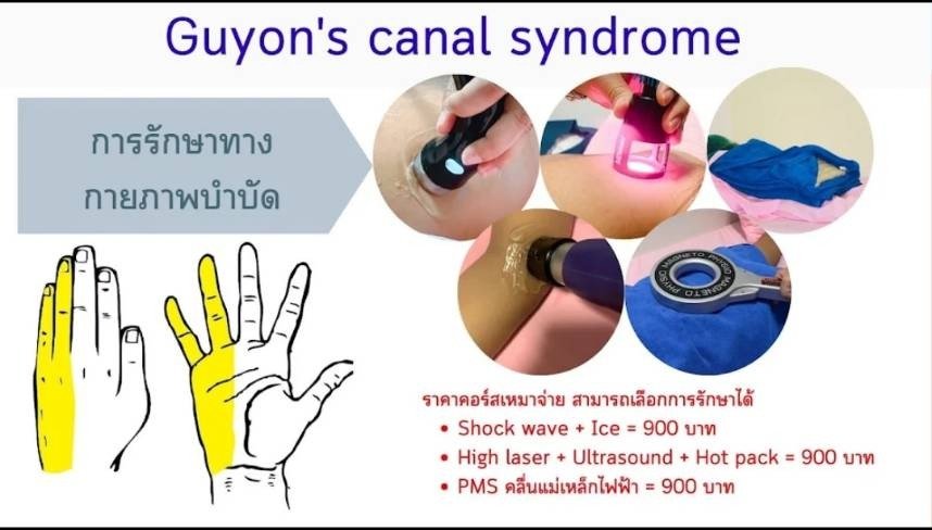 Guyon's canal syndrome