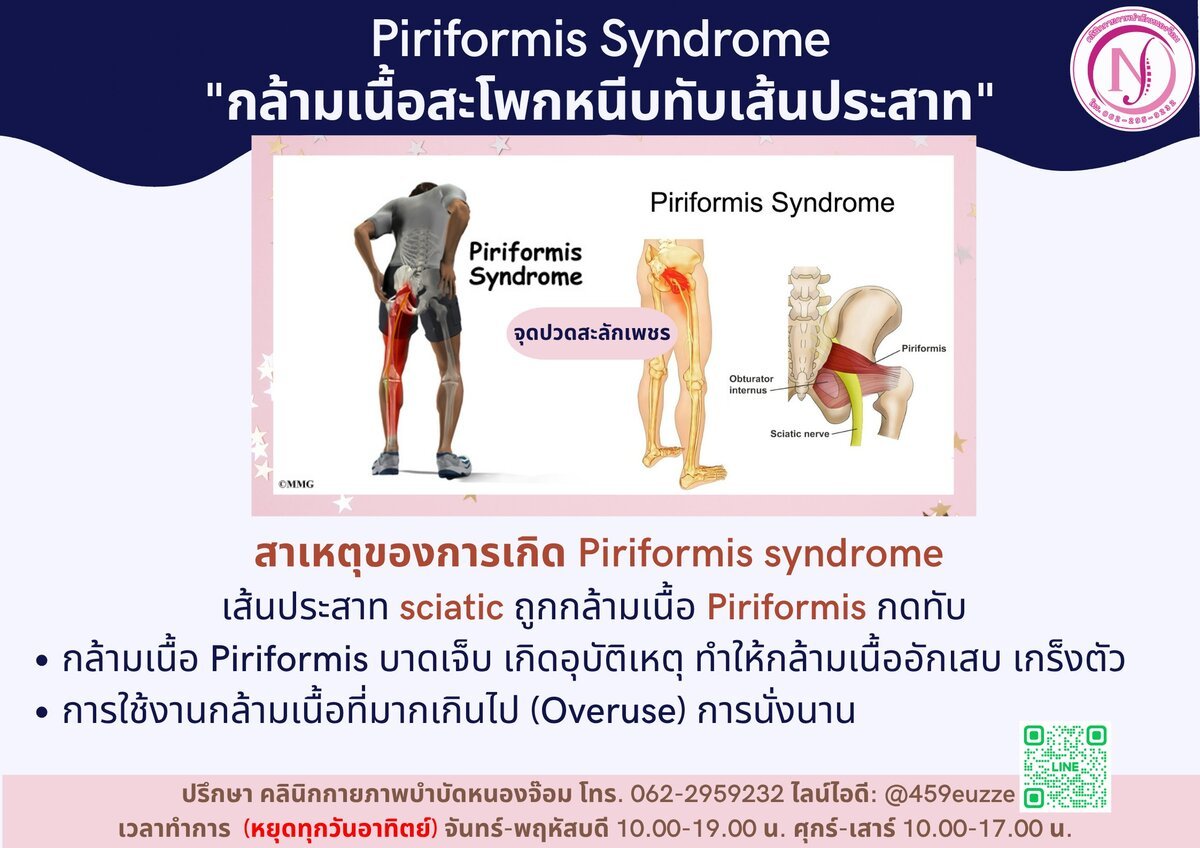 สาเหตุ Piriformis Syndrome