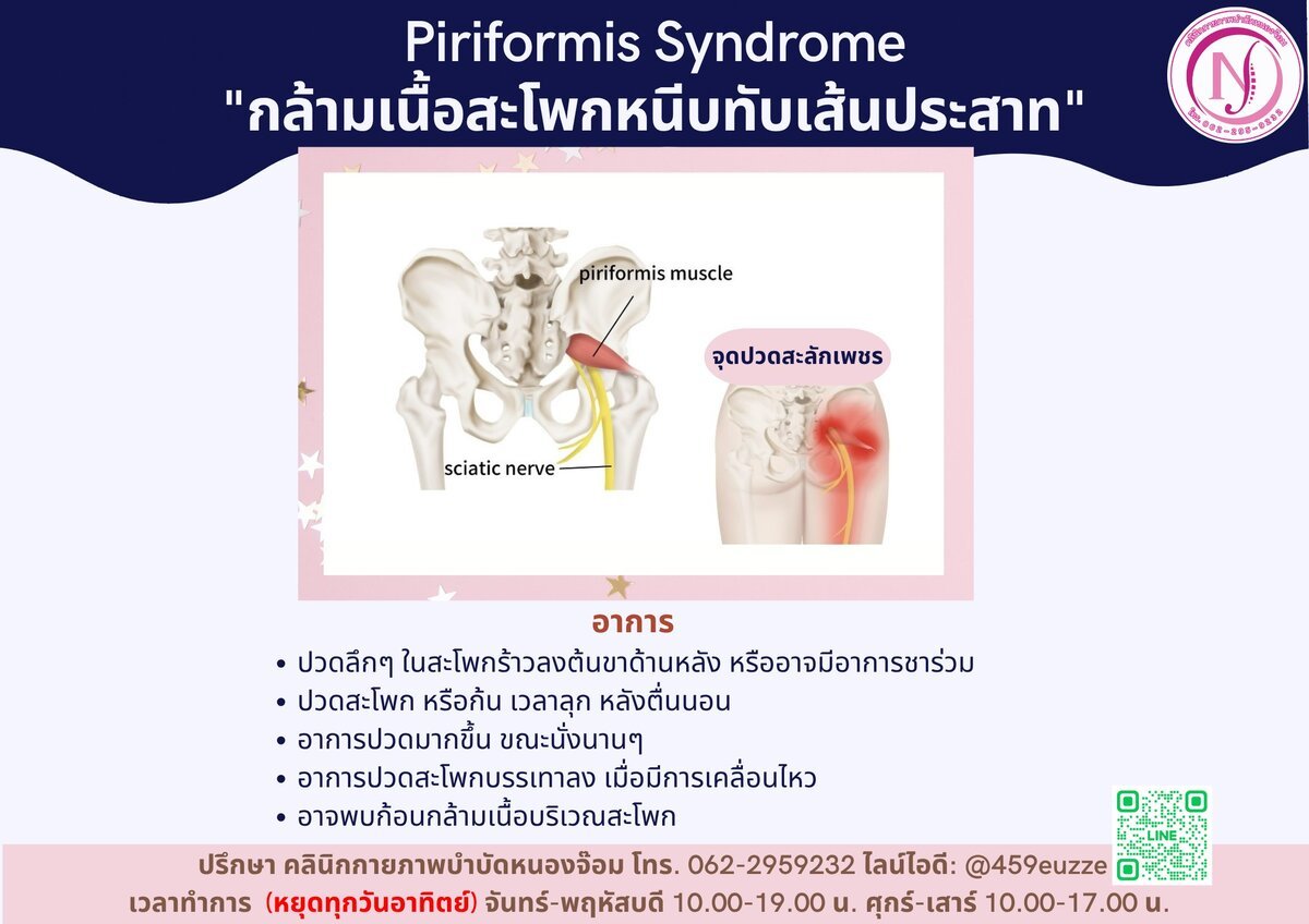 อาการ Piriformis Syndrome